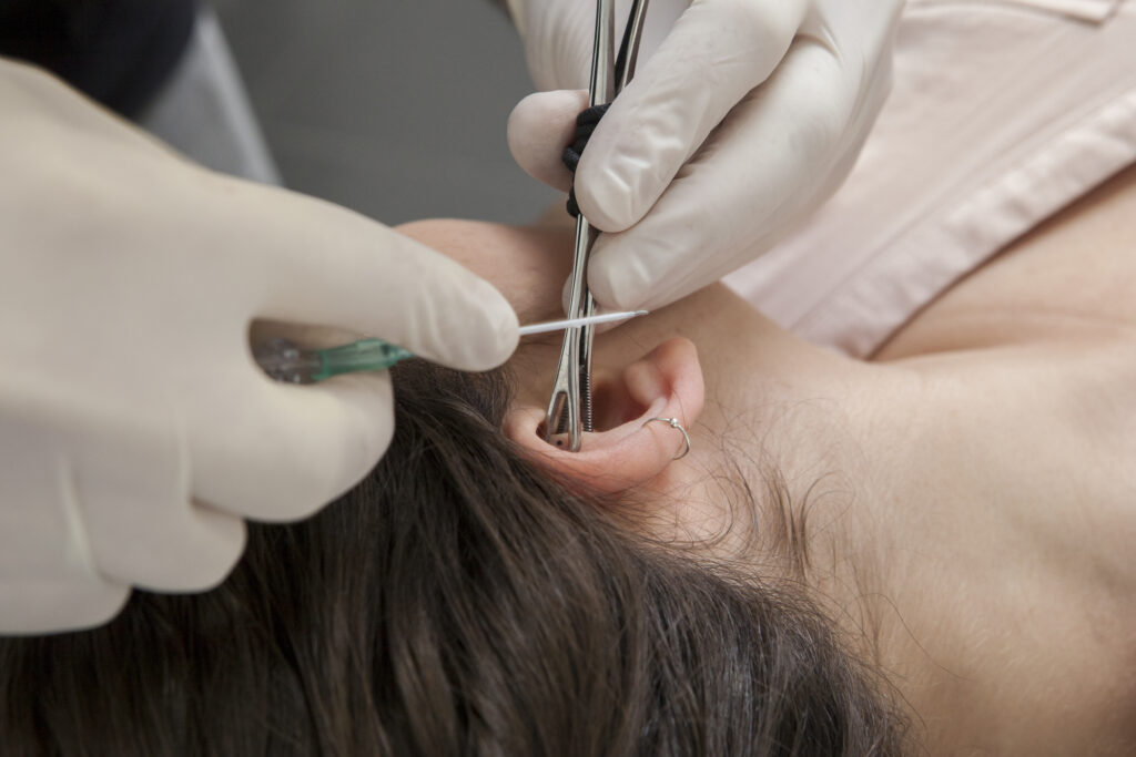 A rook ear piercing being performed by a professional piercer.